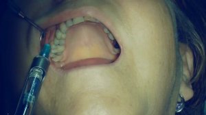 Инфильтрационная анестезия для лечения 15,14.