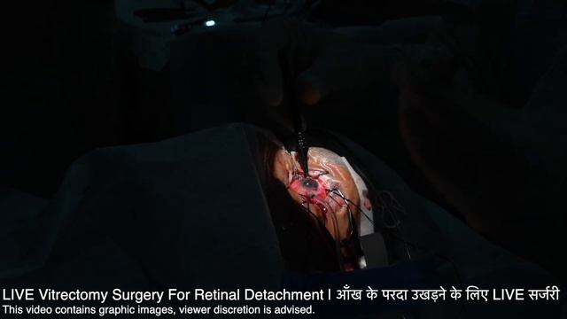 Retinal Detachment Treatment | आँख के पर्दे का इलाज -Detached Retina | Vitrectomy & Scleral Bucklin смотреть онлайн
