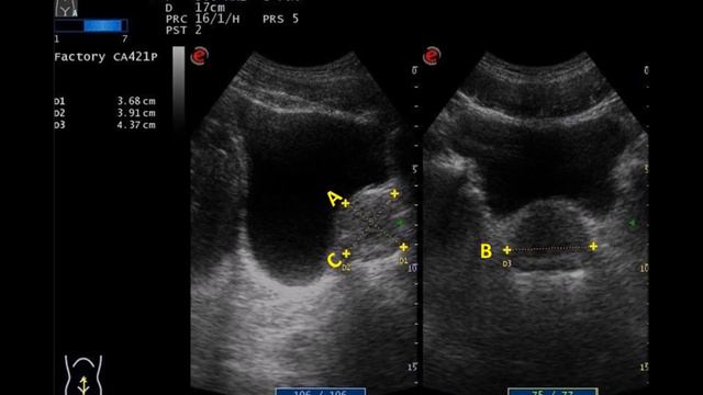 Vídeo 13 Estudio ecográfico de la próstata смотреть онлайн
