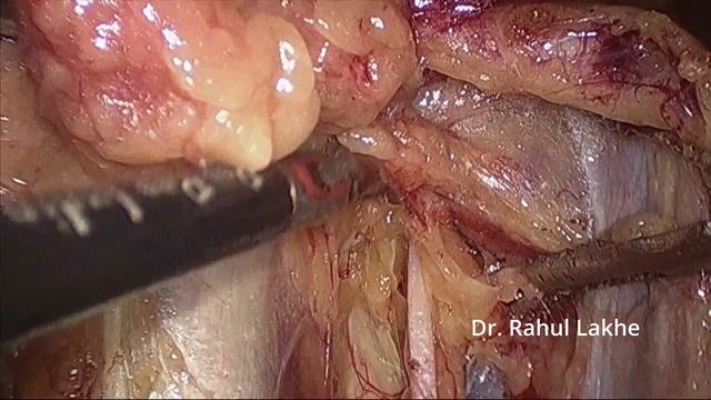 laparoscopic pelvic lymph node dissection смотреть онлайн