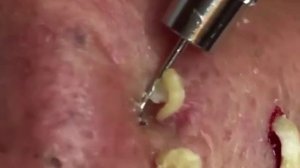 Выдавливание прыщей