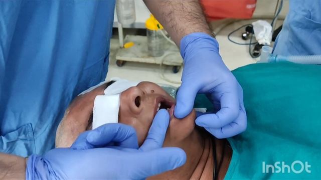 Restricted mouth opening and pediatric Tascope videolaryngoscopy intubation смотреть онлайн