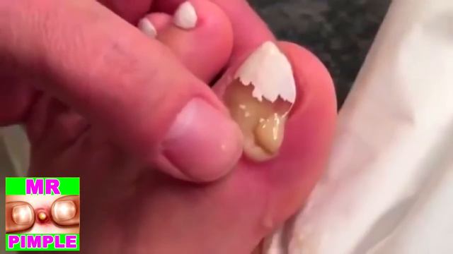 Popping Pus - Mr. Pimple