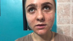 ПИЛЛИНГ ДЖЕССНЕРА. Процесс по дням. Мой опыт