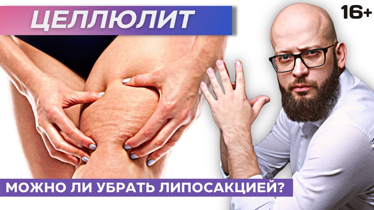 Можно ли убрать целлюлит с помощью липосакции? Что такое целлюлит? Апельсиновая корка