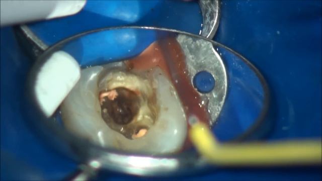 furcation perforation closure . закрытие фуркационной перфорации смотреть онлайн