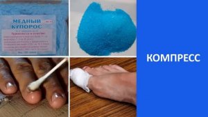 Если Замучал Грибок Ногтей То Смотрите