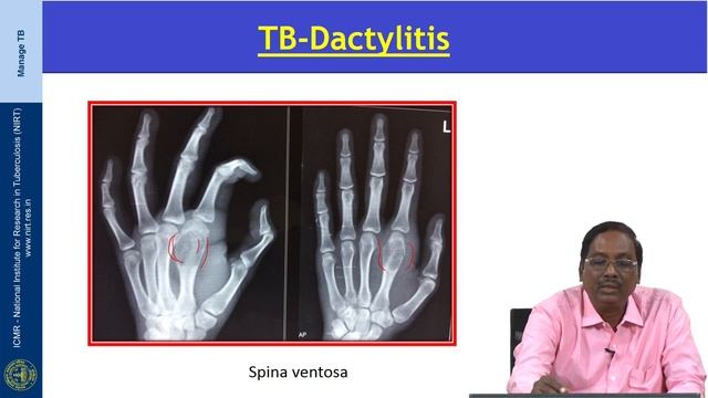 23 Radiology in diagnosis of Tuberculosis Session 04 смотреть онлайн