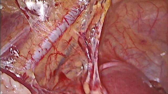 Indocyanine green in detection of sentinel lymph nodes in cervical cancer. NEUQUEN смотреть онлайн