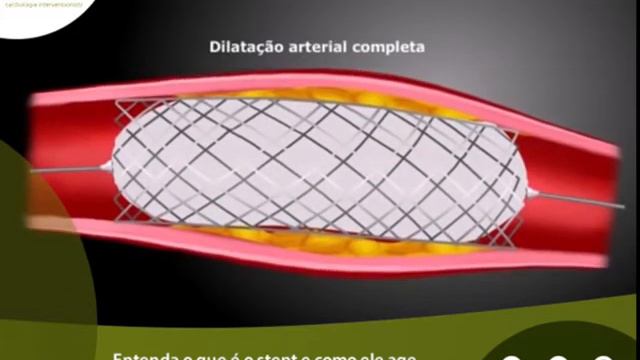Entenda o que é o stent e como ele age para desobstruir as artérias coronarianas смотреть онлайн
