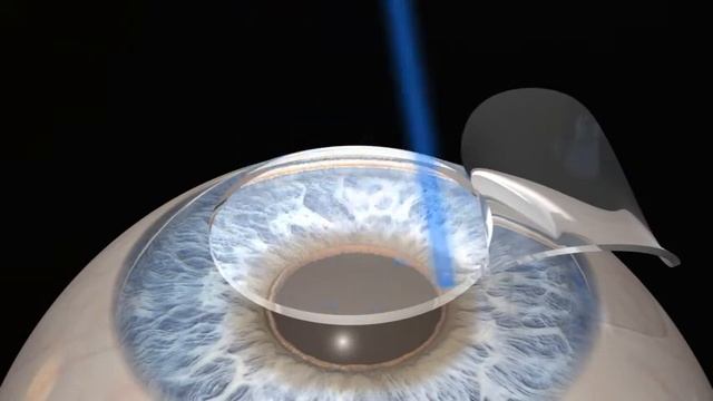 Wavefront Optimized LASIK_mpg2.mpg смотреть онлайн