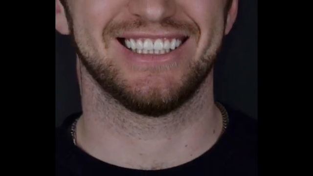 Преображение 1. Работа стоматолога-ортопеда: Мартикяна Георгия Артуровича смотреть онлайн