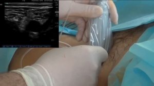 Блокада бедренного нерва однократная