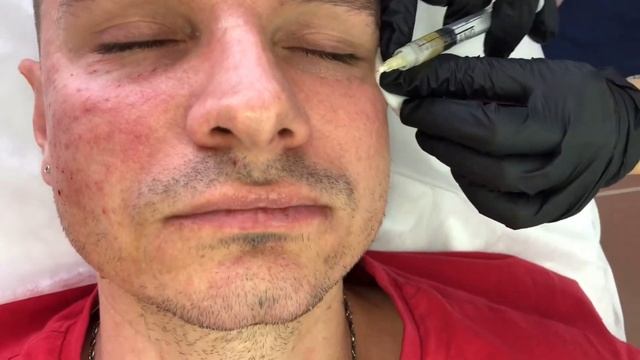 Биоревитализация для красивого пациента! смотреть онлайн