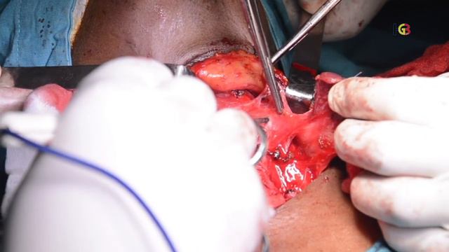 Cirurgia Tiroide смотреть онлайн