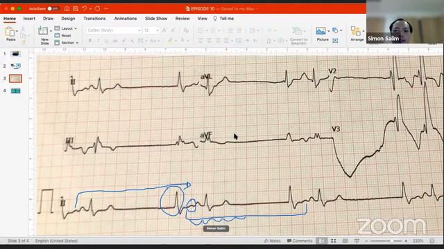 EKG Club IDI Cabang Medan - Episode 10 : Sinus Pause смотреть онлайн
