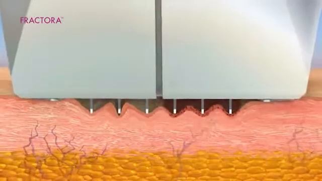 Anti Aging Radiofrequency Treatment Watch How Fractora Works смотреть онлайн