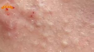 Удаление прыщей с носа и щек Spa G #052