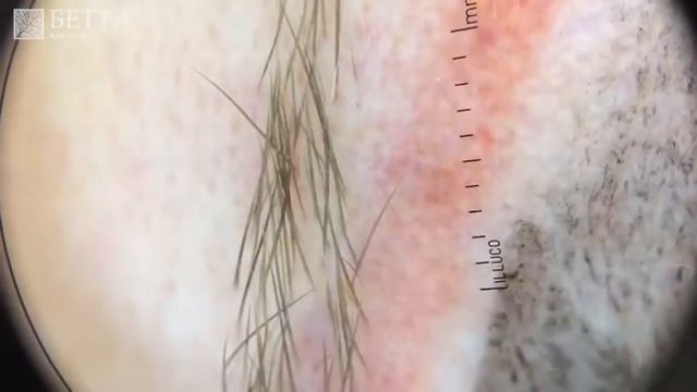 Лечение рубца после татуажа. Лечение рубцов. Бетта Клиника, Нижний Новгород смотреть онлайн