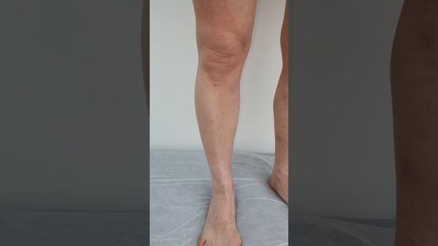 Результат операции удаление варикоза. Лечение варикоза. Флеболог Москва смотреть онлайн