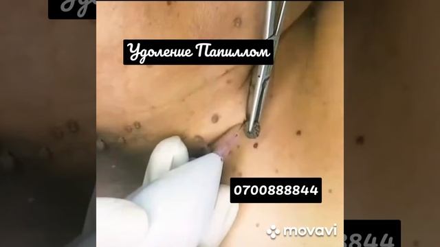 Лазерное удаление Подошвенных бородавок и Папиллом.±996700888844 смотреть онлайн