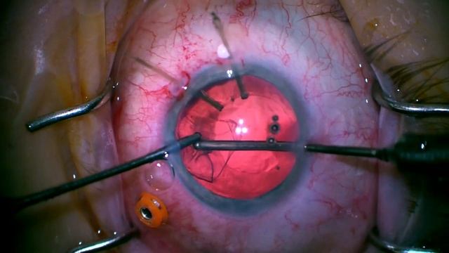 Traumatic Cataract removal with vitreous prolapse management AND atonic pupil repair смотреть онлайн