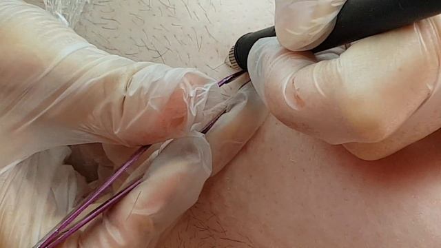 Электиоэпиляция смотреть онлайн
