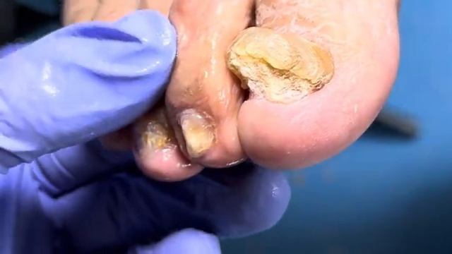 Super Thick Onychomycosis, Repair It Layer By Layer With Pliers【Doctor Liu Pedicure】