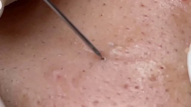 Удаление черных точек 2022 EP23 смотреть онлайн