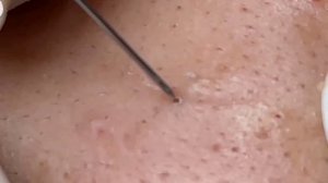 Удаление черных точек 2022 EP23