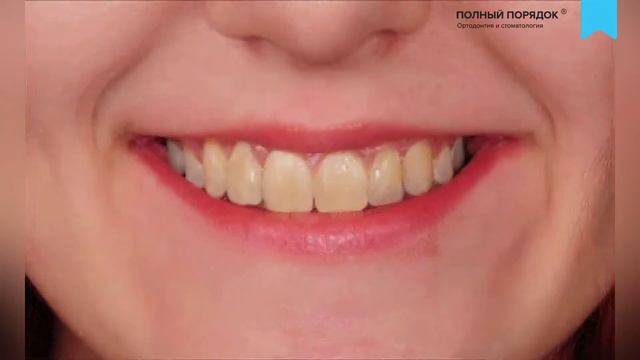 Сложное лечение скученности с удалением, занявшее целых 4 года. смотреть онлайн