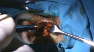 Rzayev R.M. Врожденный околоушный свищ - иссечение свища.