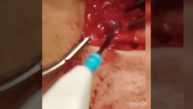 sentinel lymph node biopsy-SLNB -methylene blue -breast cancer смотреть онлайн