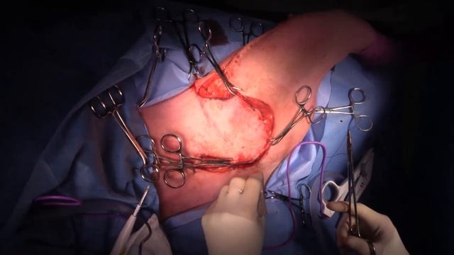 Live stream - inguinal mass removal in a dog смотреть онлайн