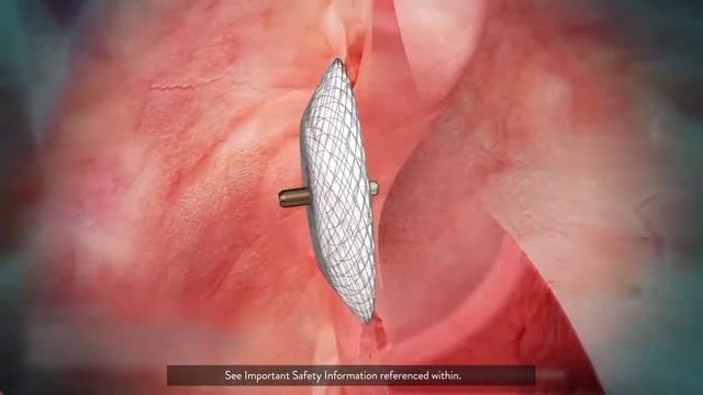 Amplatzer PFO Occluder For Patent Foramen Ovale Closure