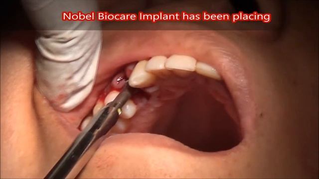 Cost of single nobel dental implants in chennai смотреть онлайн