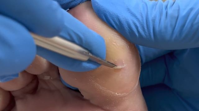 Thick calluses on toes caused by prolonged friction【Xue Yidao】 смотреть онлайн