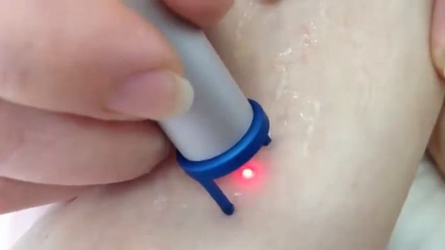 Удаление сосудов лазером в клинике Венус, Киев смотреть онлайн