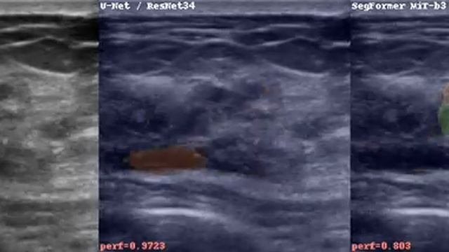 Semantic Segmentation for Medical Ultrasound Imaging смотреть онлайн