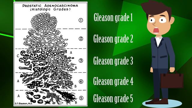 Epstein outs Gleason score: 1/3: Fix Gleason grade смотреть онлайн