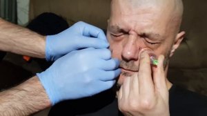 Хиджама от гайморита