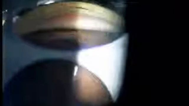 Гониоскопия - 3 смотреть онлайн