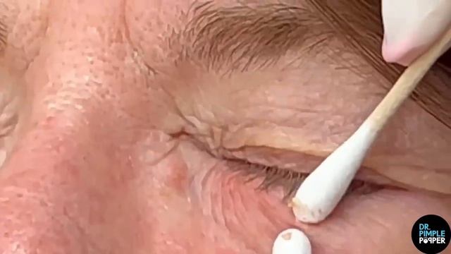 Blackhead Eye Squeeze