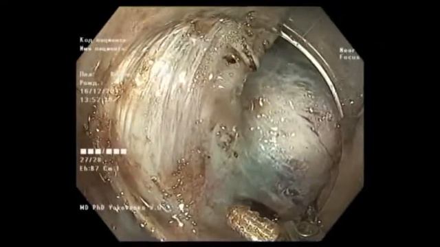Giant tubular-papillary adenoma of sigmoid colon. Dual-focus, NBI, EUS, ESD смотреть онлайн