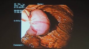 05 Свитина КА – Экстренное эндоскопическое лечение пациента с ГИСО желудка, осложненной кровотечение