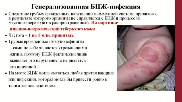 3.3. Оказание неотложной помощи при поствакцинальных осложнениях.mp4 смотреть онлайн