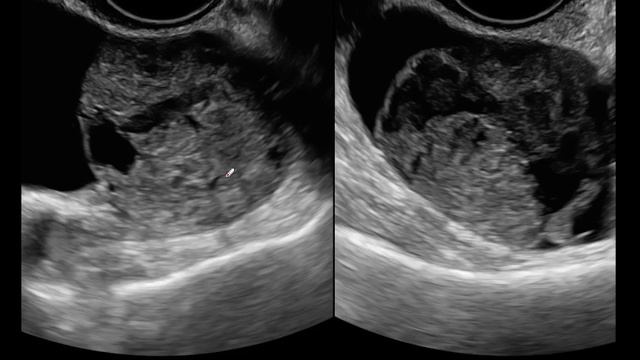 Gynaecological Imaging IV: Malignant Ovarian Tumours смотреть онлайн