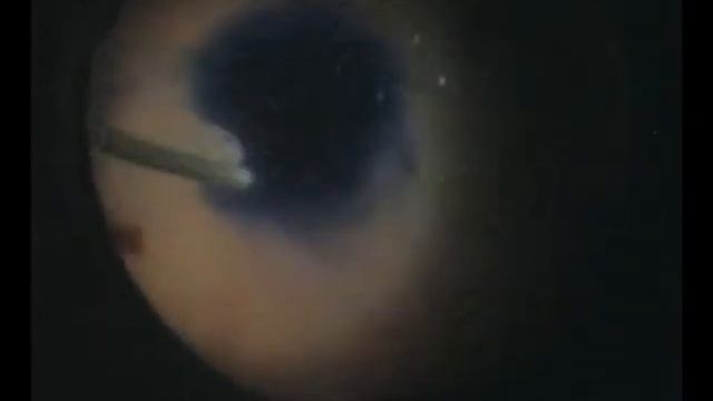 Байбородов Я.В. OS – неполный макулярный разрыв, эпиретинальный фиброз смотреть онлайн