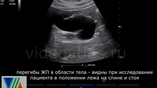 S-образный желчный пузырь смотреть онлайн