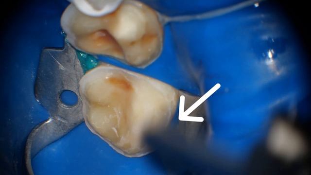 Изоляция коффердамом  Лайфхак 2